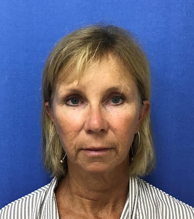 Face Lift Before & After Gallery - Patient 91514596 - Image 1