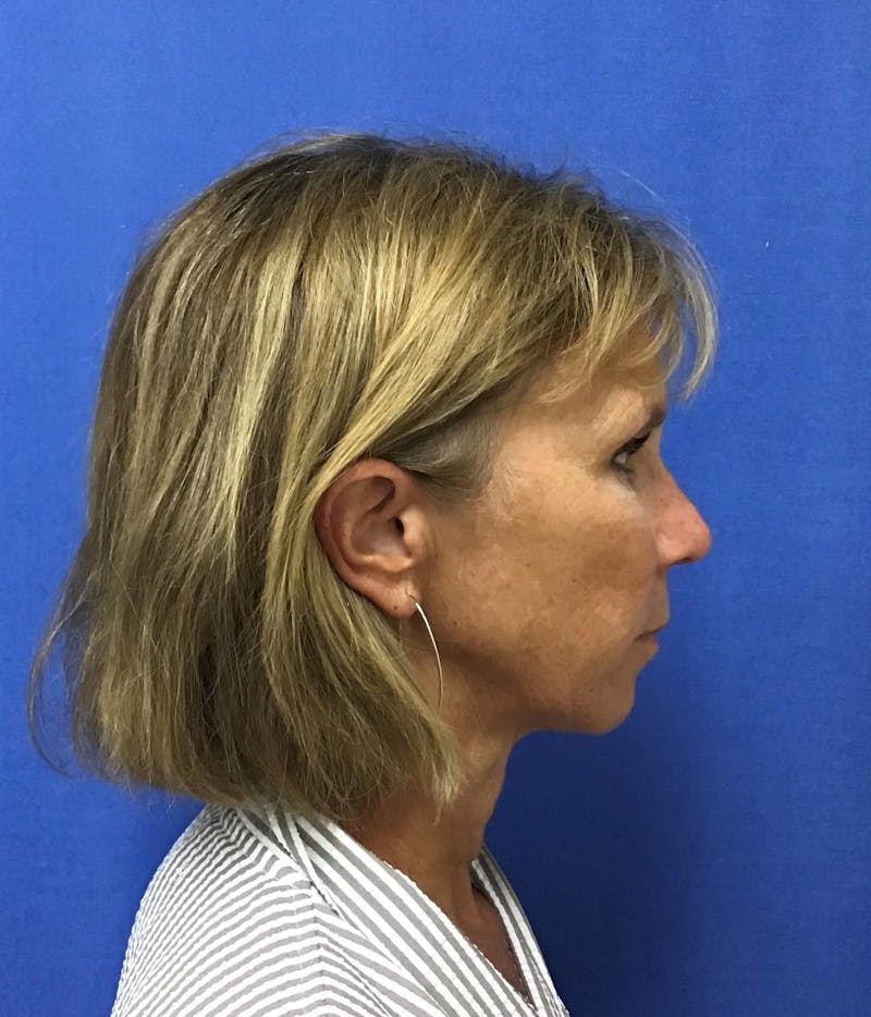 Face Lift Before & After Gallery - Patient 91514596 - Image 5