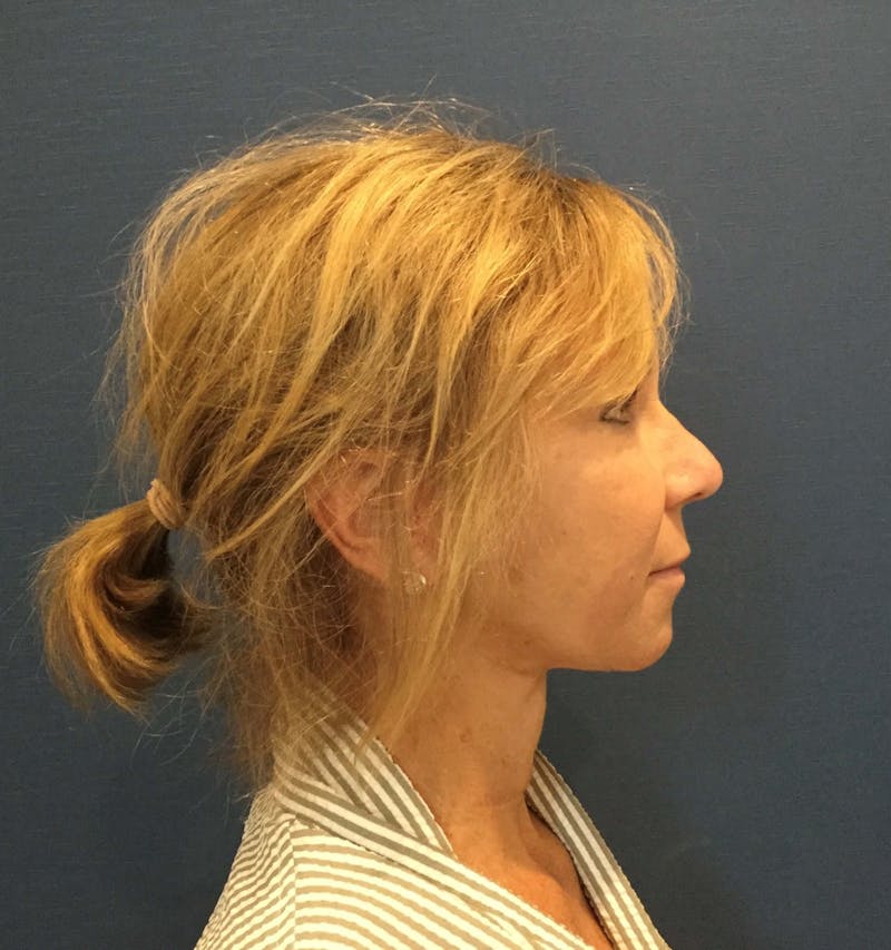 Face Lift Before & After Gallery - Patient 91514596 - Image 6