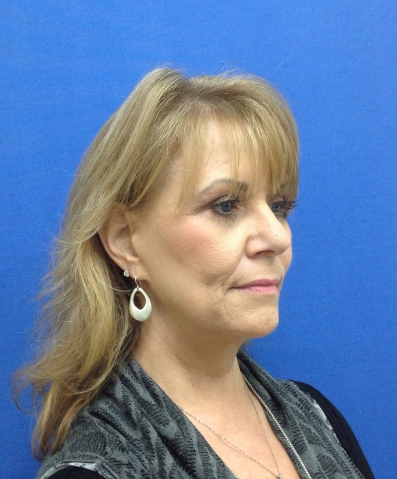 Face Lift Before & After Gallery - Patient 91514598 - Image 4