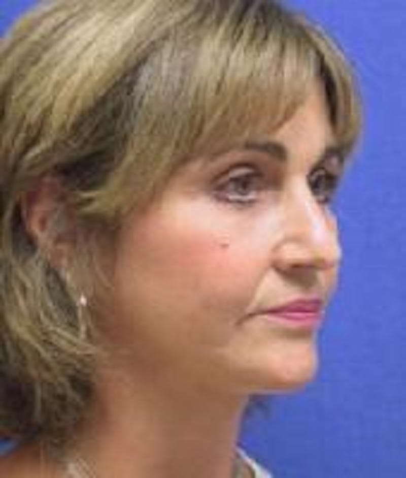 Face Lift Before & After Gallery - Patient 91514599 - Image 4