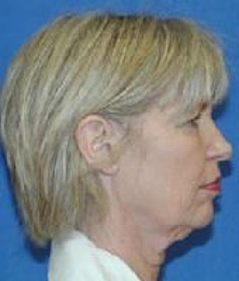 Face Lift Before & After Gallery - Patient 91514600 - Image 5