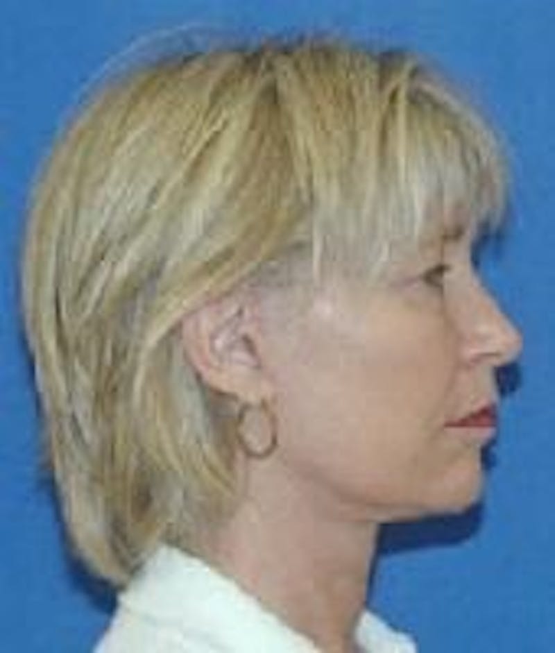 Face Lift Before & After Gallery - Patient 91514600 - Image 6