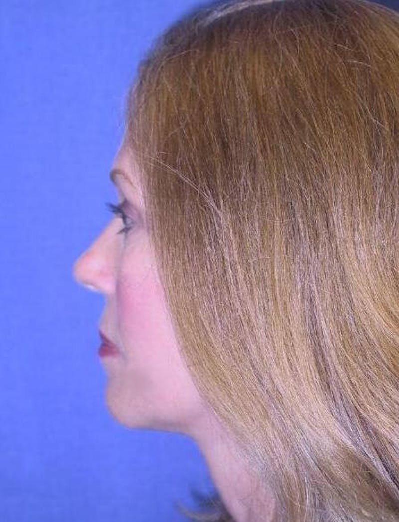 Face Lift Before & After Gallery - Patient 91514604 - Image 6