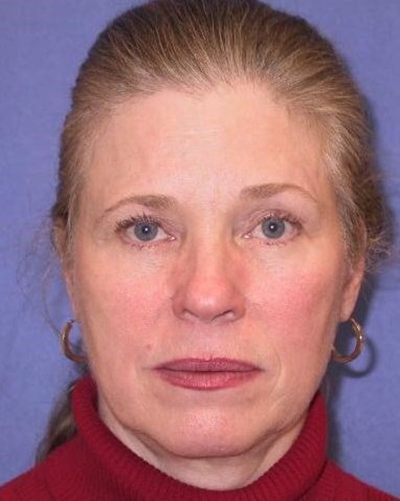 Face Lift Before & After Gallery - Patient 91514604 - Image 5