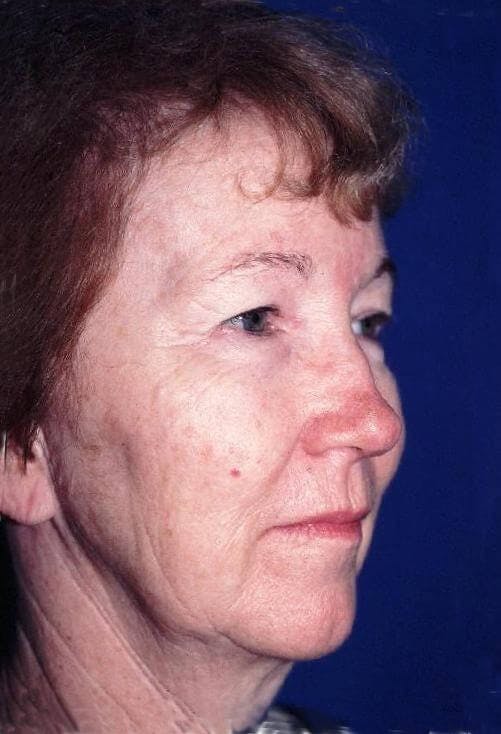 Face Lift Gallery - Patient 91514606 - Image 1