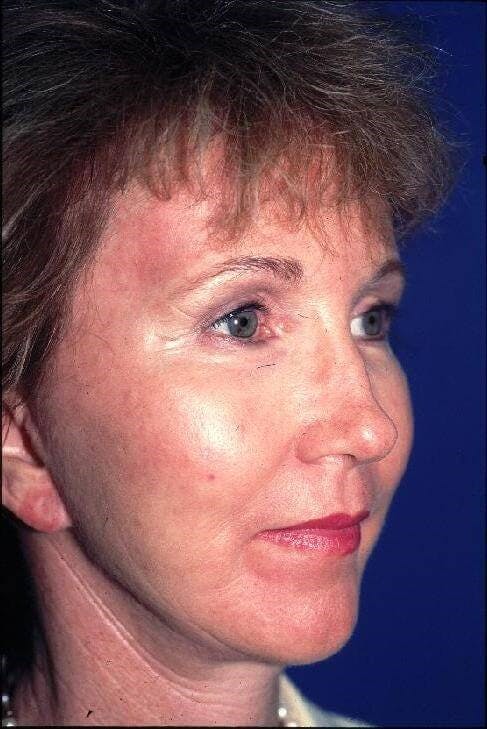 Face Lift Gallery - Patient 91514606 - Image 2
