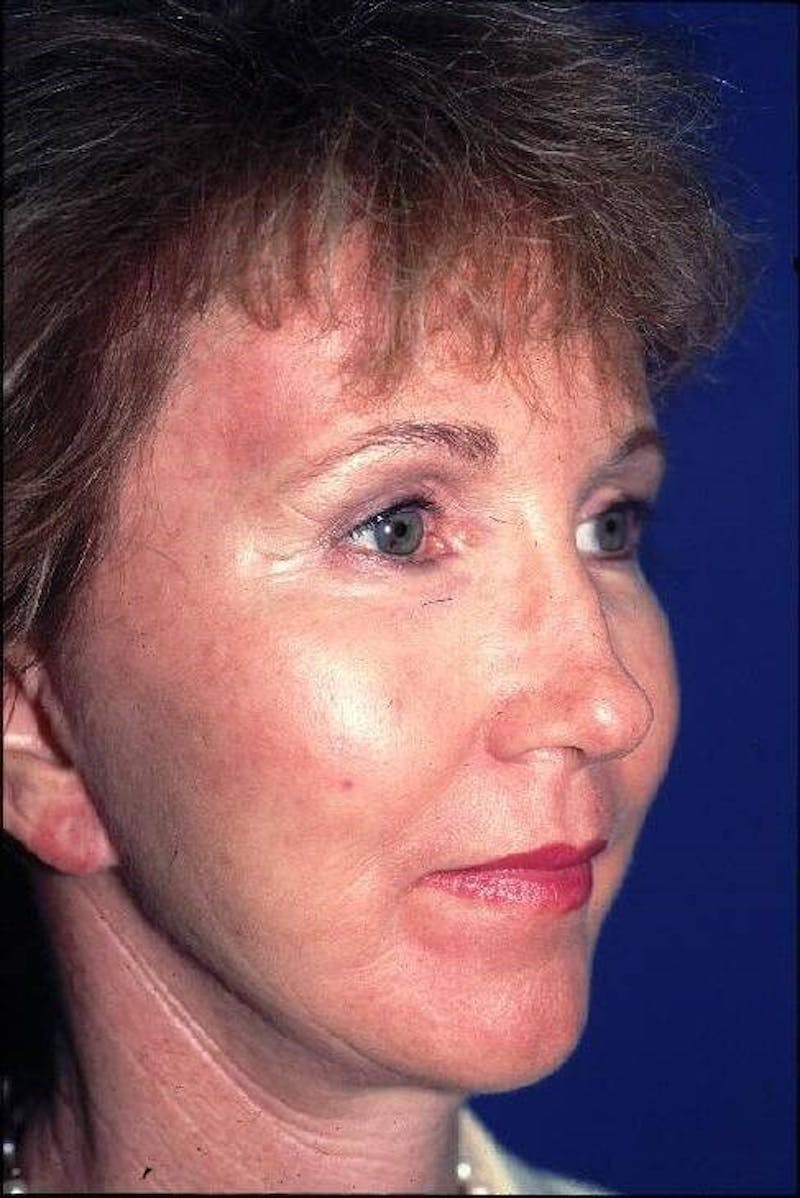 Face Lift Before & After Gallery - Patient 91514606 - Image 4
