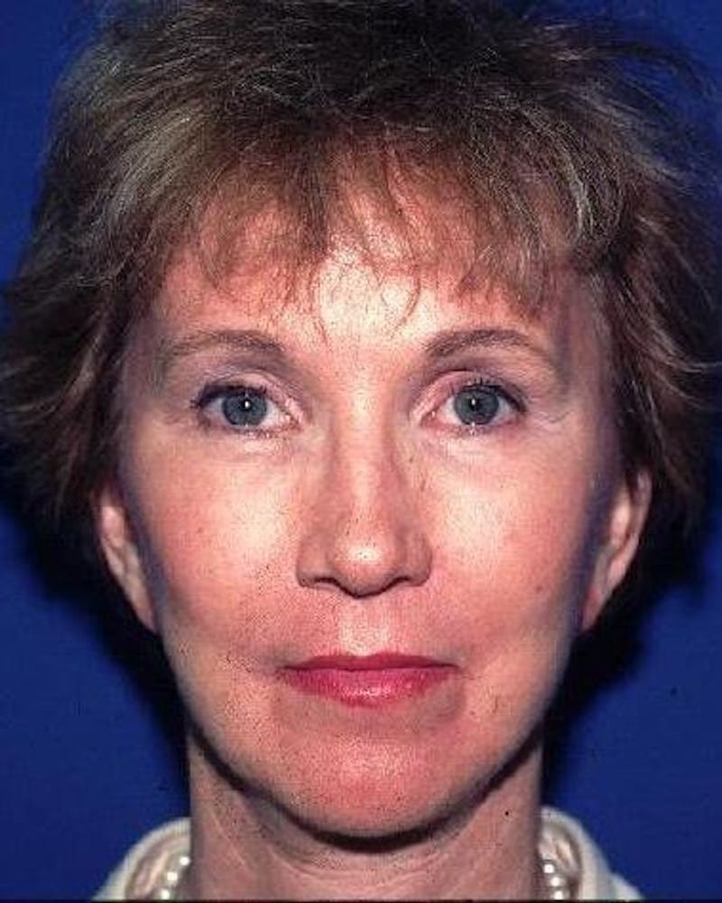 Face Lift Before & After Gallery - Patient 91514606 - Image 2