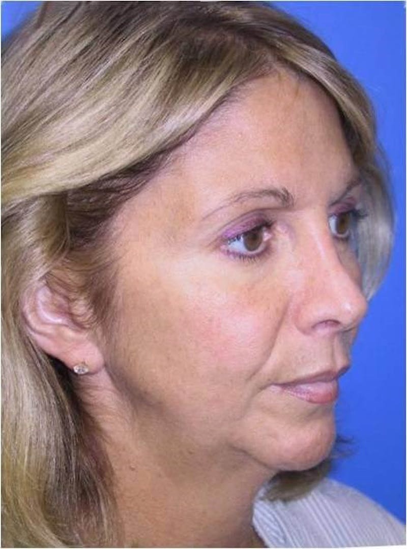 Face Lift Before & After Gallery - Patient 91514607 - Image 1