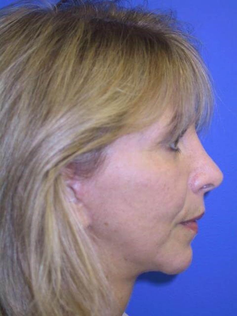 Face Lift Before & After Gallery - Patient 91514607 - Image 4