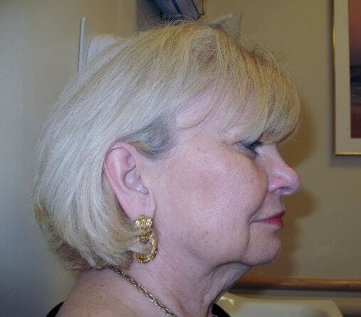 Face Lift Gallery - Patient 91514609 - Image 1