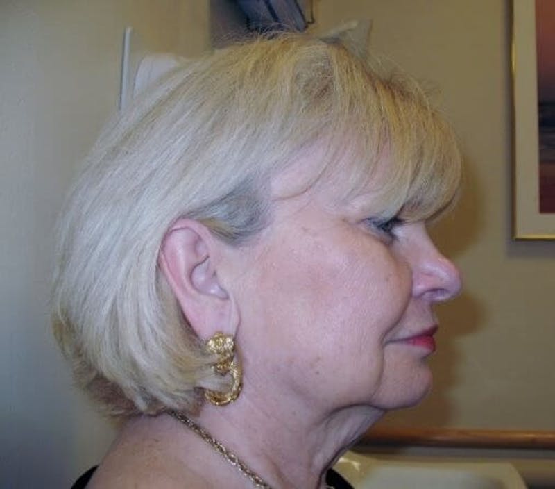 Face Lift Before & After Gallery - Patient 91514609 - Image 3