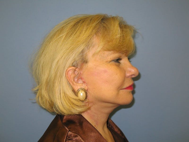Face Lift Before & After Gallery - Patient 91514609 - Image 4