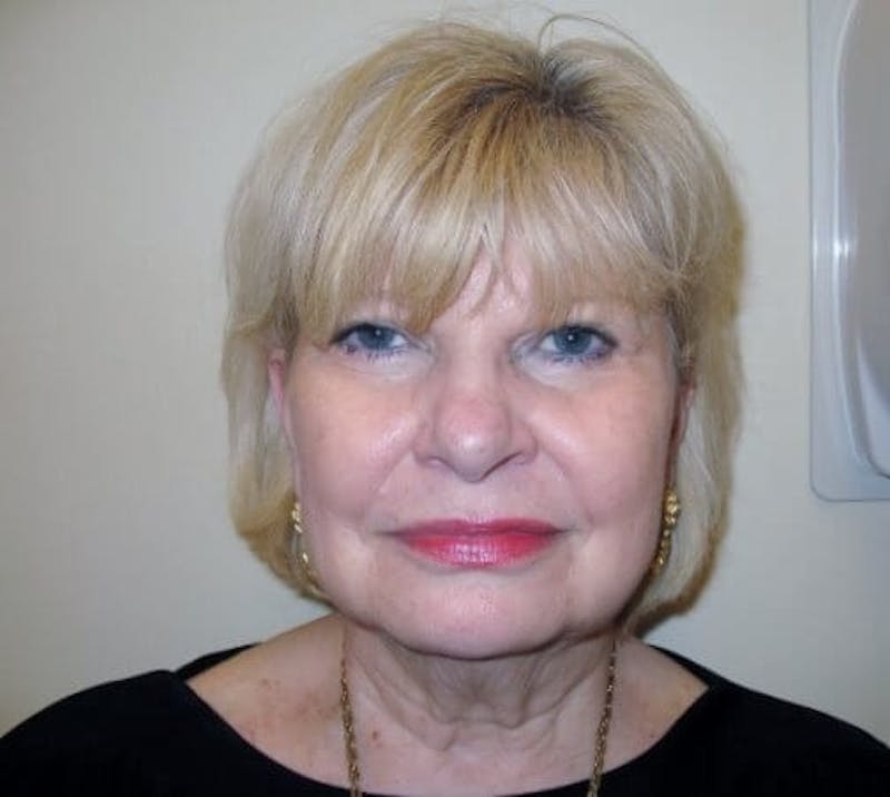 Face Lift Before & After Gallery - Patient 91514609 - Image 1