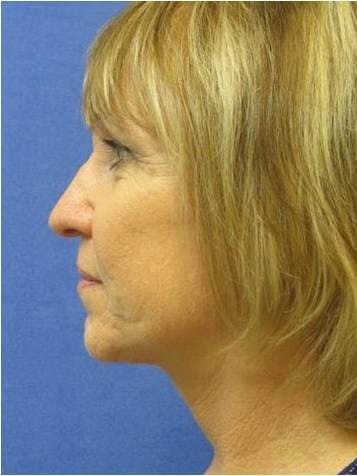 Face Lift Gallery - Patient 91514612 - Image 2