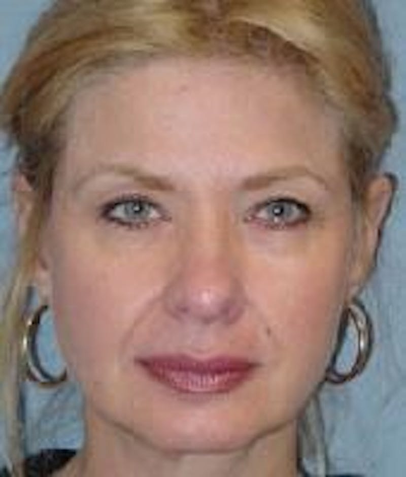 Face Lift Before & After Gallery - Patient 91514615 - Image 1