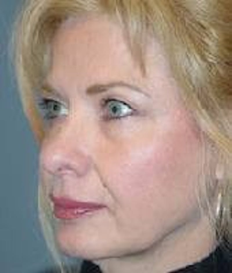 Face Lift Before & After Gallery - Patient 91514615 - Image 3