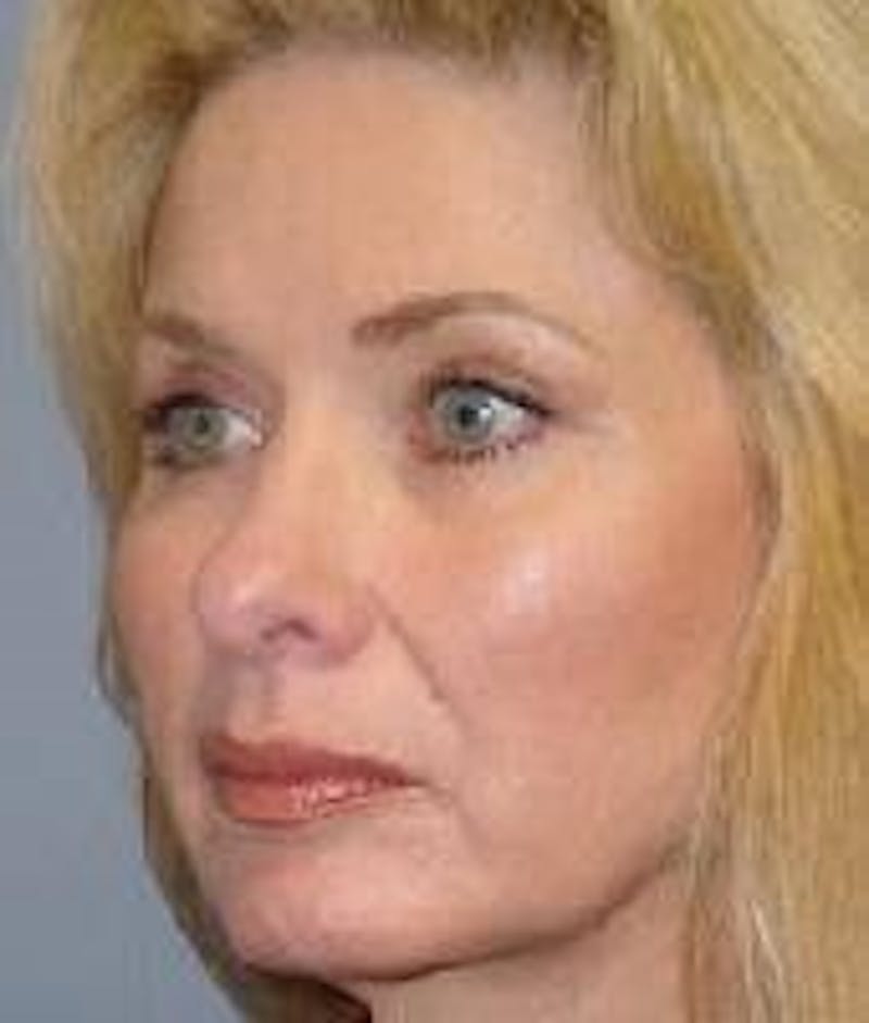 Face Lift Before & After Gallery - Patient 91514615 - Image 4