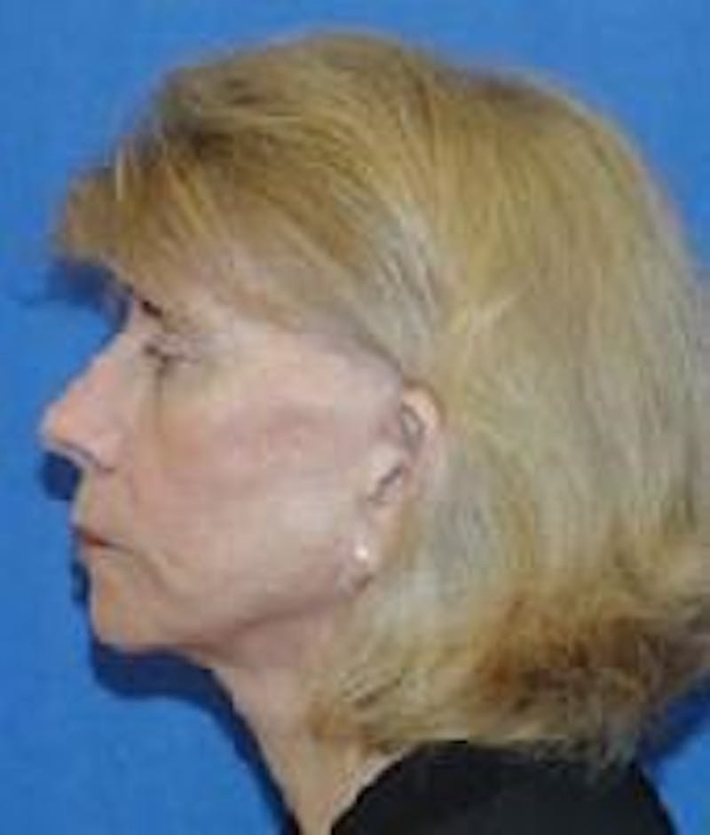 Face Lift Before & After Gallery - Patient 91514637 - Image 5