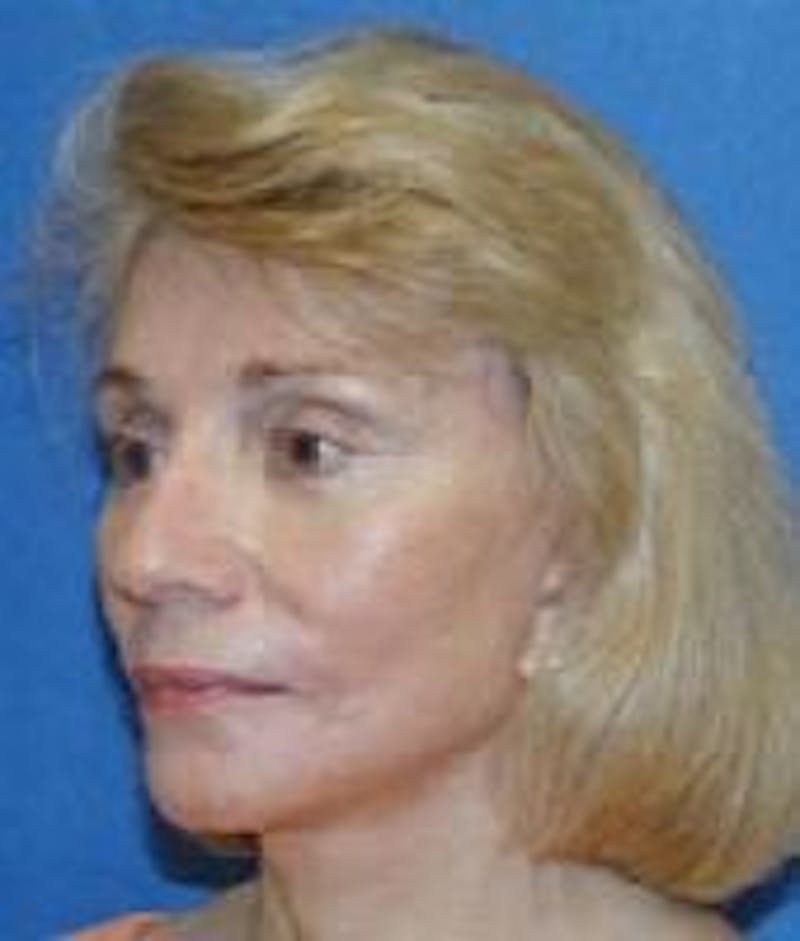 Face Lift Before & After Gallery - Patient 91514637 - Image 4