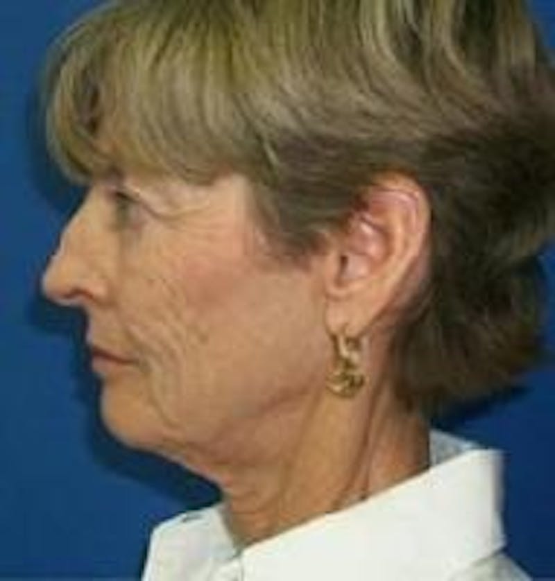 Face Lift Before & After Gallery - Patient 91514638 - Image 5