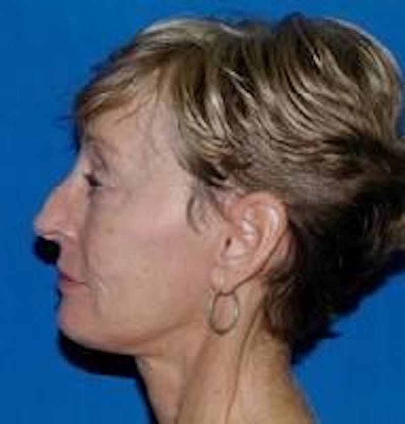 Face Lift Before & After Gallery - Patient 91514638 - Image 6