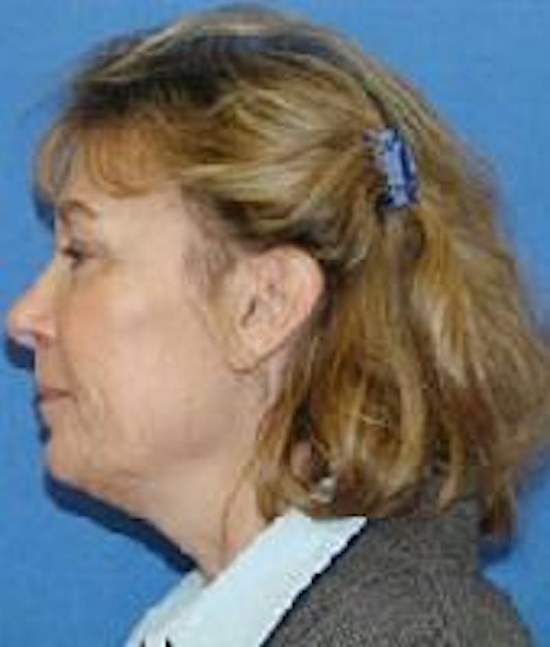 Face Lift Before & After Gallery - Patient 91514639 - Image 5
