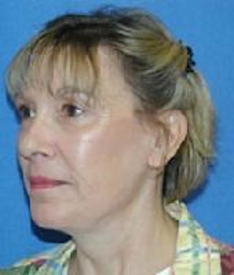 Face Lift Before & After Gallery - Patient 91514639 - Image 4