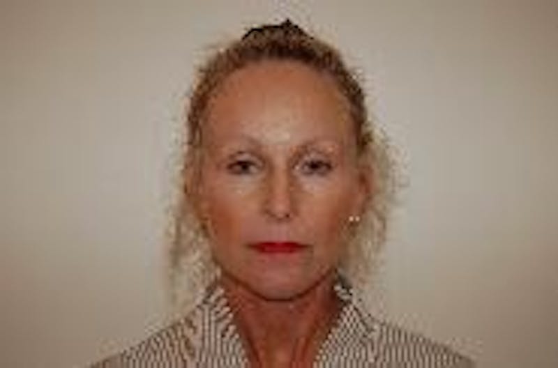 Face Lift Before & After Gallery - Patient 91514642 - Image 2