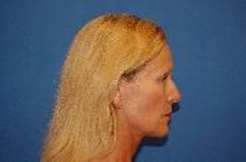 Face Lift Before & After Gallery - Patient 91514642 - Image 5