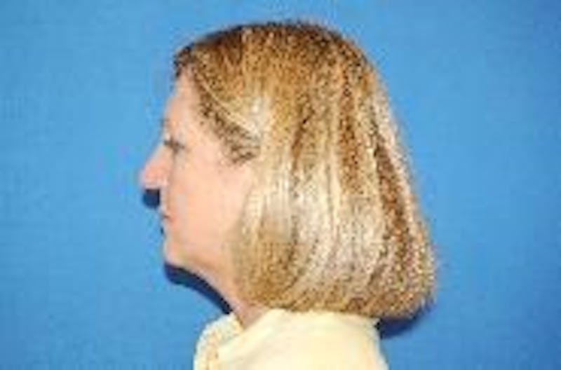 Face Lift Before & After Gallery - Patient 91514644 - Image 5
