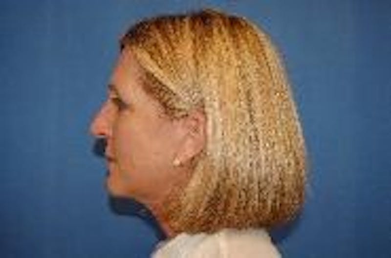 Face Lift Before & After Gallery - Patient 91514644 - Image 6
