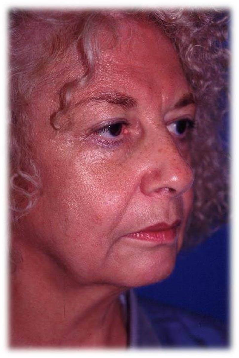 Face Lift Before & After Gallery - Patient 91514646 - Image 1