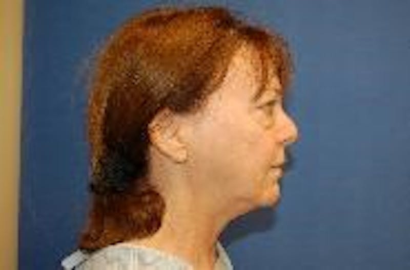 Face Lift Before & After Gallery - Patient 91514651 - Image 5
