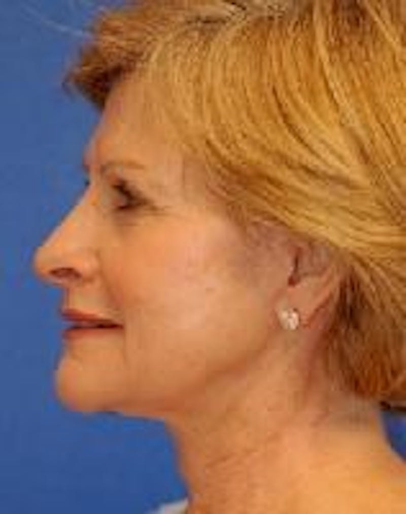 Face Lift Before & After Gallery - Patient 91514666 - Image 6