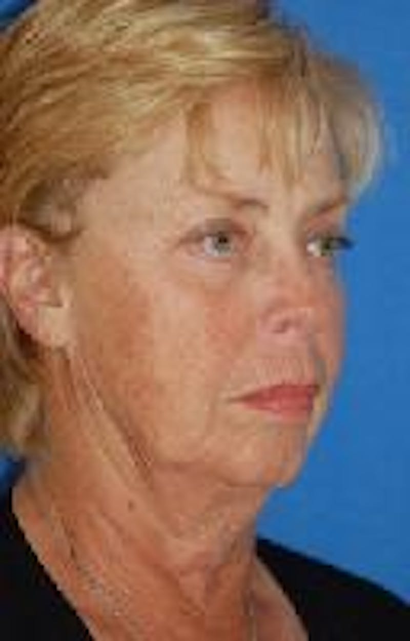 Face Lift Before & After Gallery - Patient 91514675 - Image 3