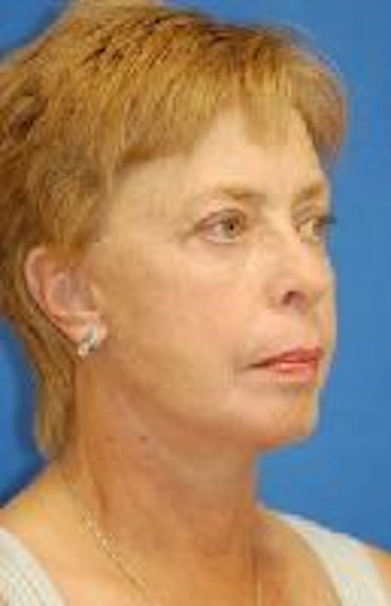 Face Lift Before & After Gallery - Patient 91514675 - Image 4