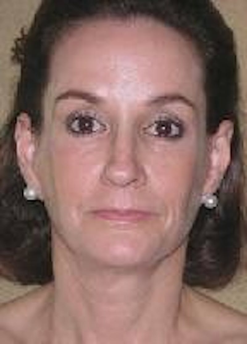 Face Lift Before & After Gallery - Patient 91514677 - Image 2