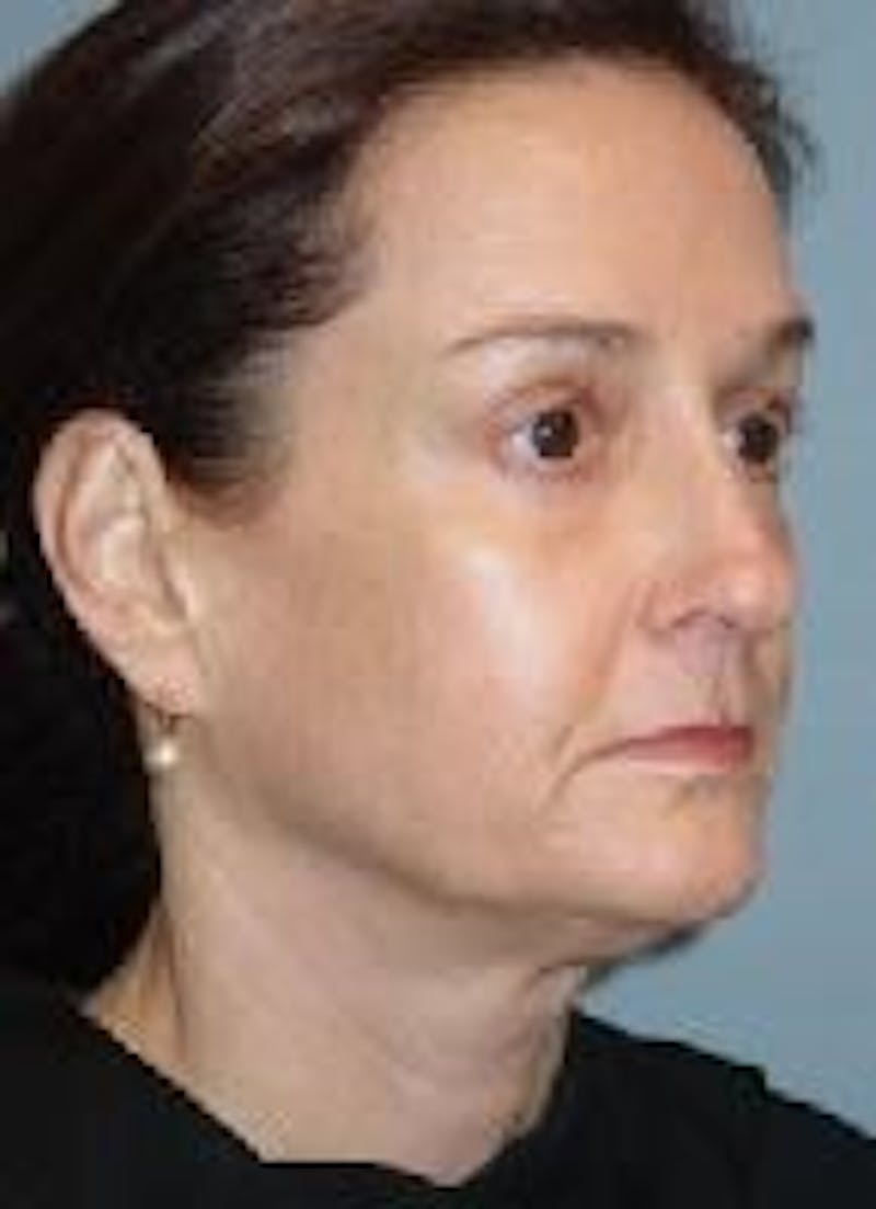 Face Lift Before & After Gallery - Patient 91514677 - Image 3