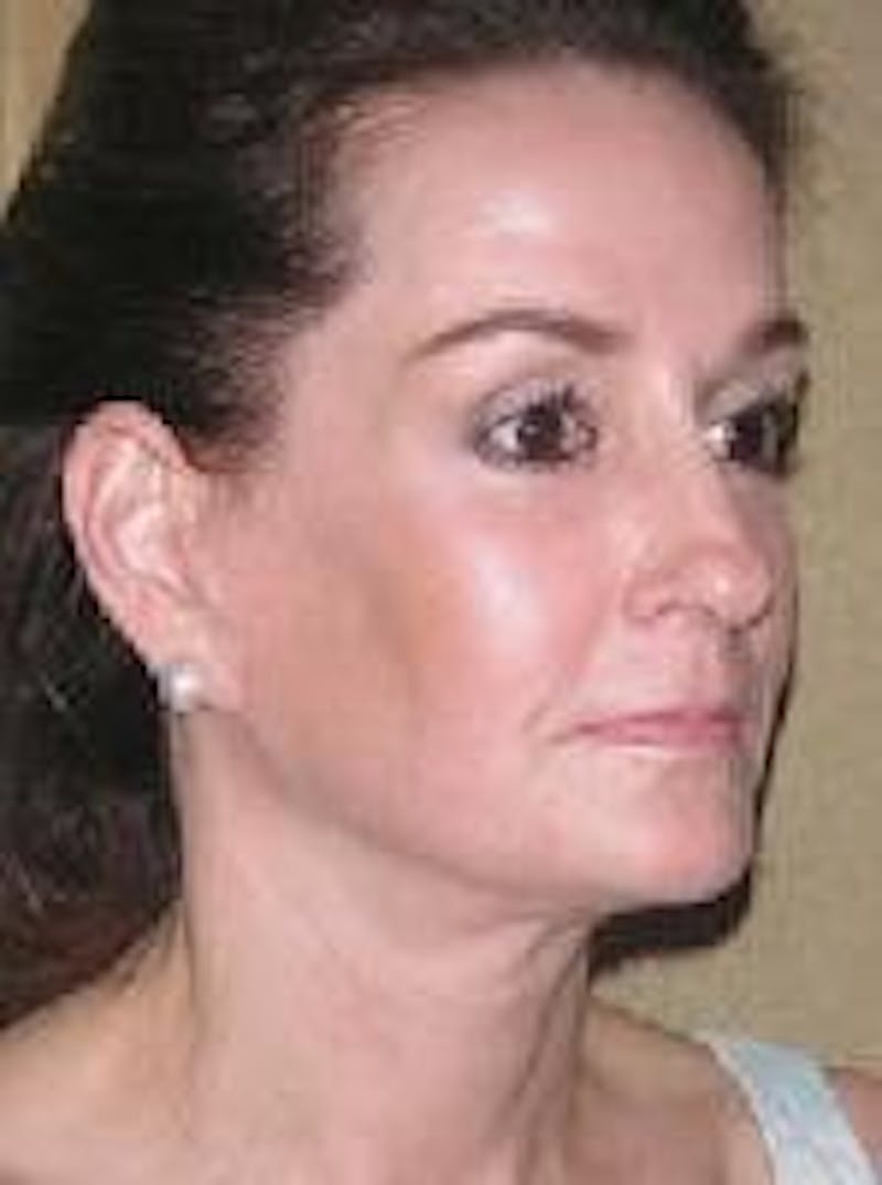 Face Lift Before & After Gallery - Patient 91514677 - Image 4