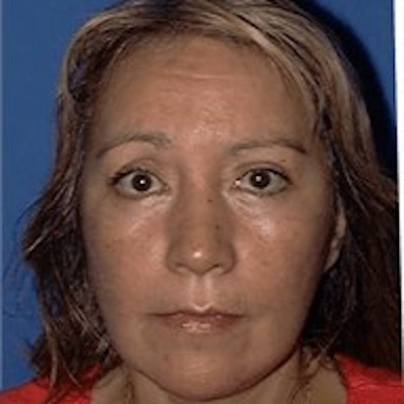 Face Lift Before & After Gallery - Patient 91514679 - Image 2