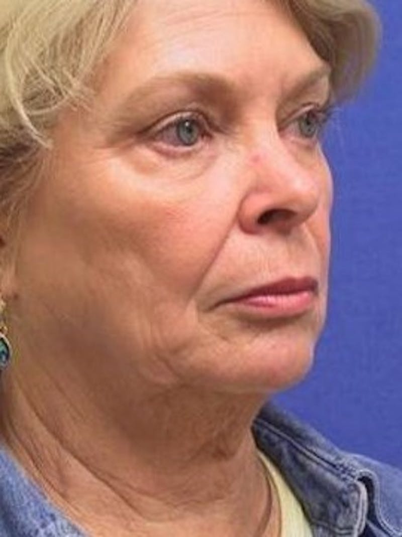 Face Lift Before & After Gallery - Patient 91514683 - Image 1
