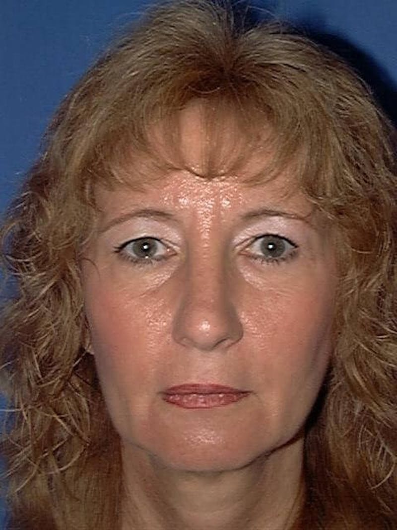 Face Lift Before & After Gallery - Patient 91514692 - Image 1