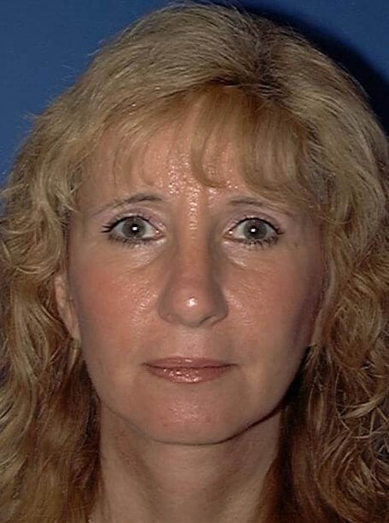 Face Lift Before & After Gallery - Patient 91514692 - Image 2
