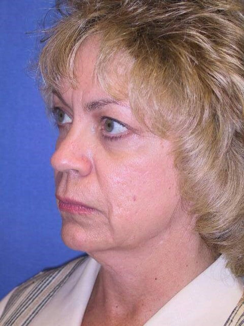 Face Lift Before & After Gallery - Patient 91514693 - Image 3