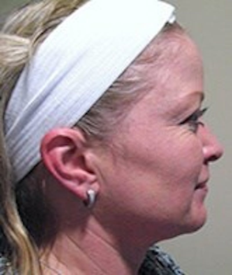 Face Lift Before & After Gallery - Patient 91514696 - Image 3