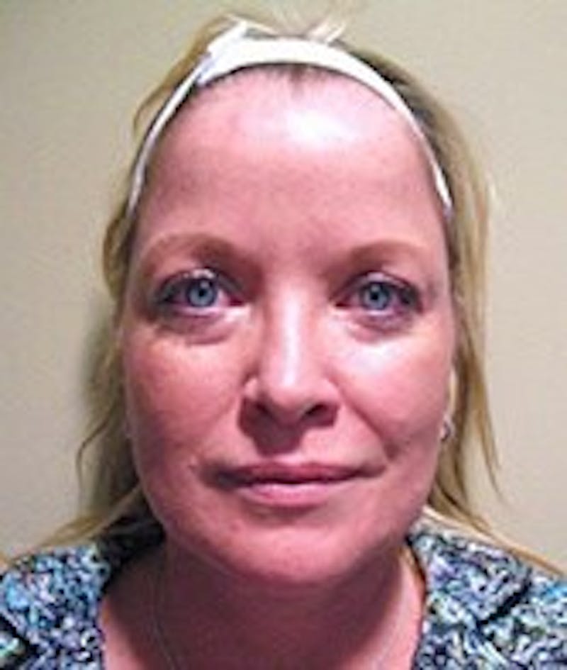 Face Lift Before & After Gallery - Patient 91514696 - Image 1