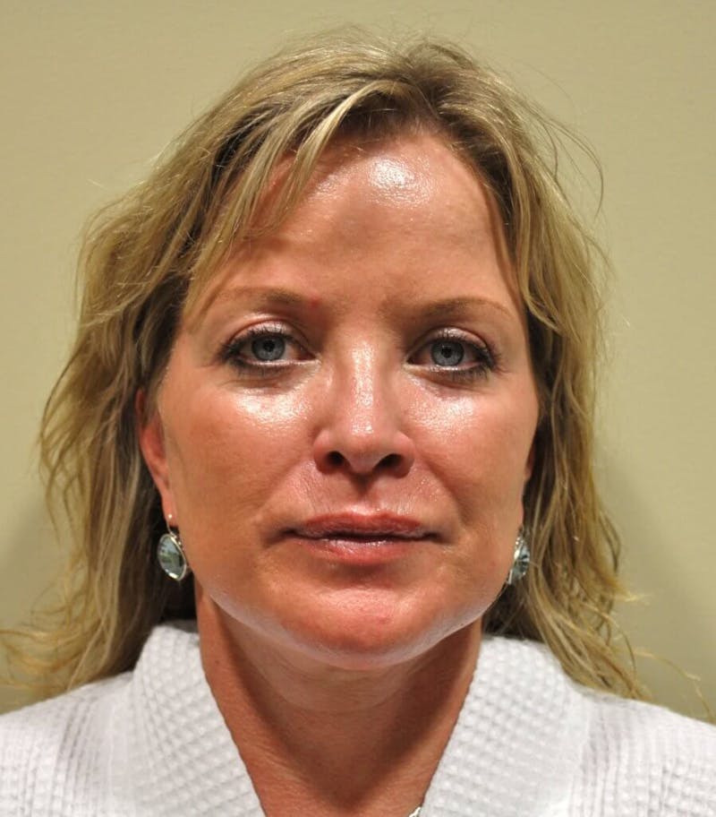 Face Lift Before & After Gallery - Patient 91514696 - Image 2