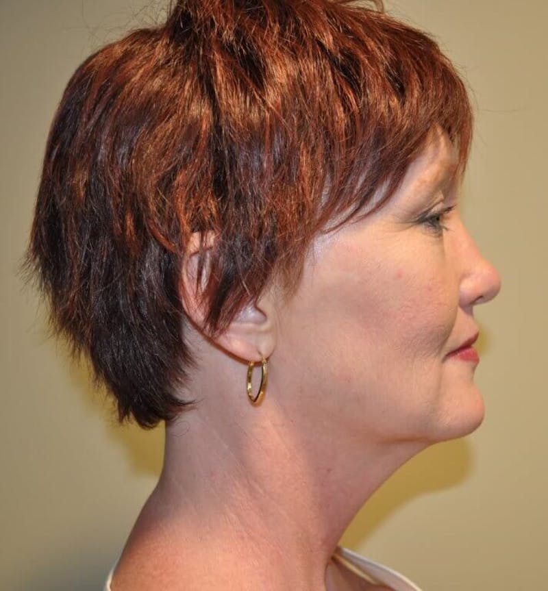 Face Lift Before & After Gallery - Patient 91514717 - Image 3